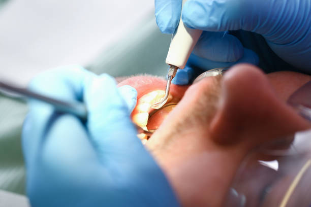 Best Emergency Root Canal Treatment in Buda, TX